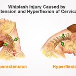 Whiplash vs Neck Strain: How PT Treats Each Condition